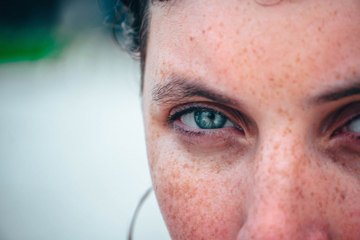 Hyperpigmentation: What Causes Dark Spots