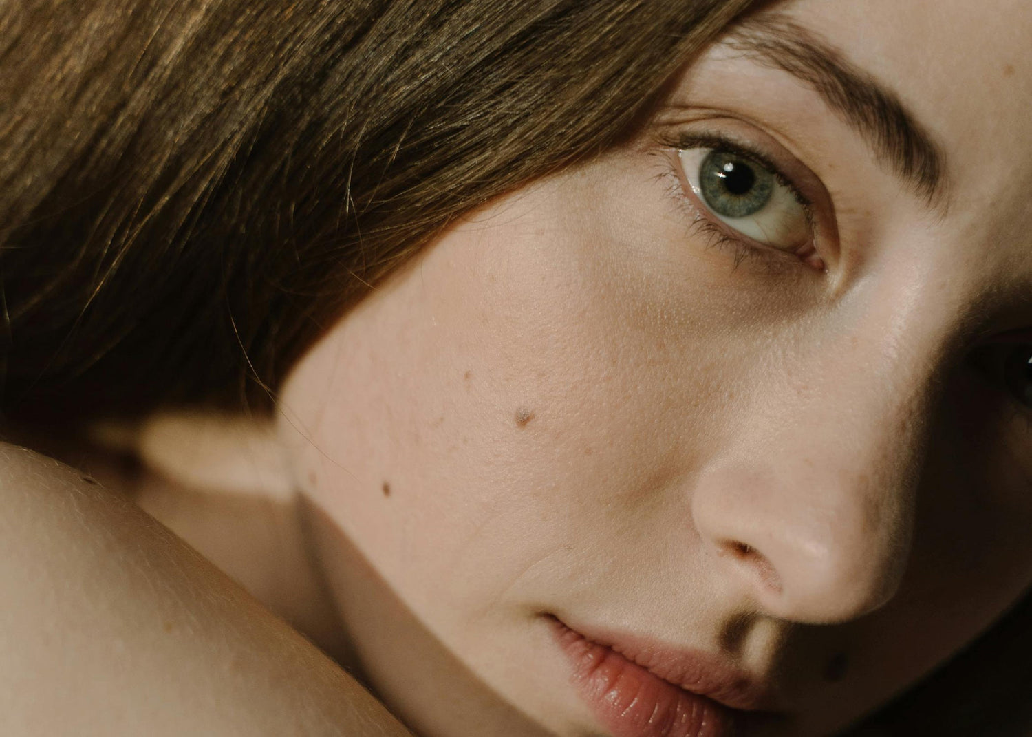 What Is Hyperpigmentation? Causes, Types, and How to Treat It