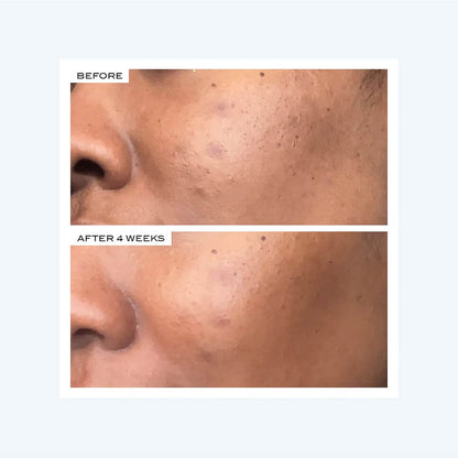 Precision Peel
