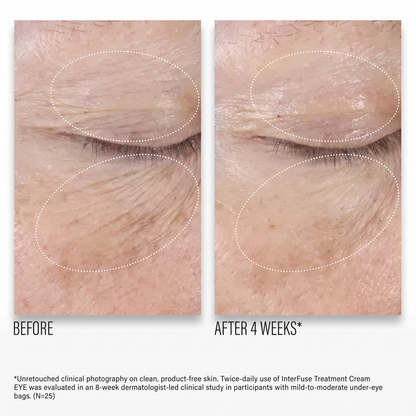 Shop Rescue Spa InterFuse Treatment Cream EYE before and after showing reduced wrinkles and smoother under-eye skin