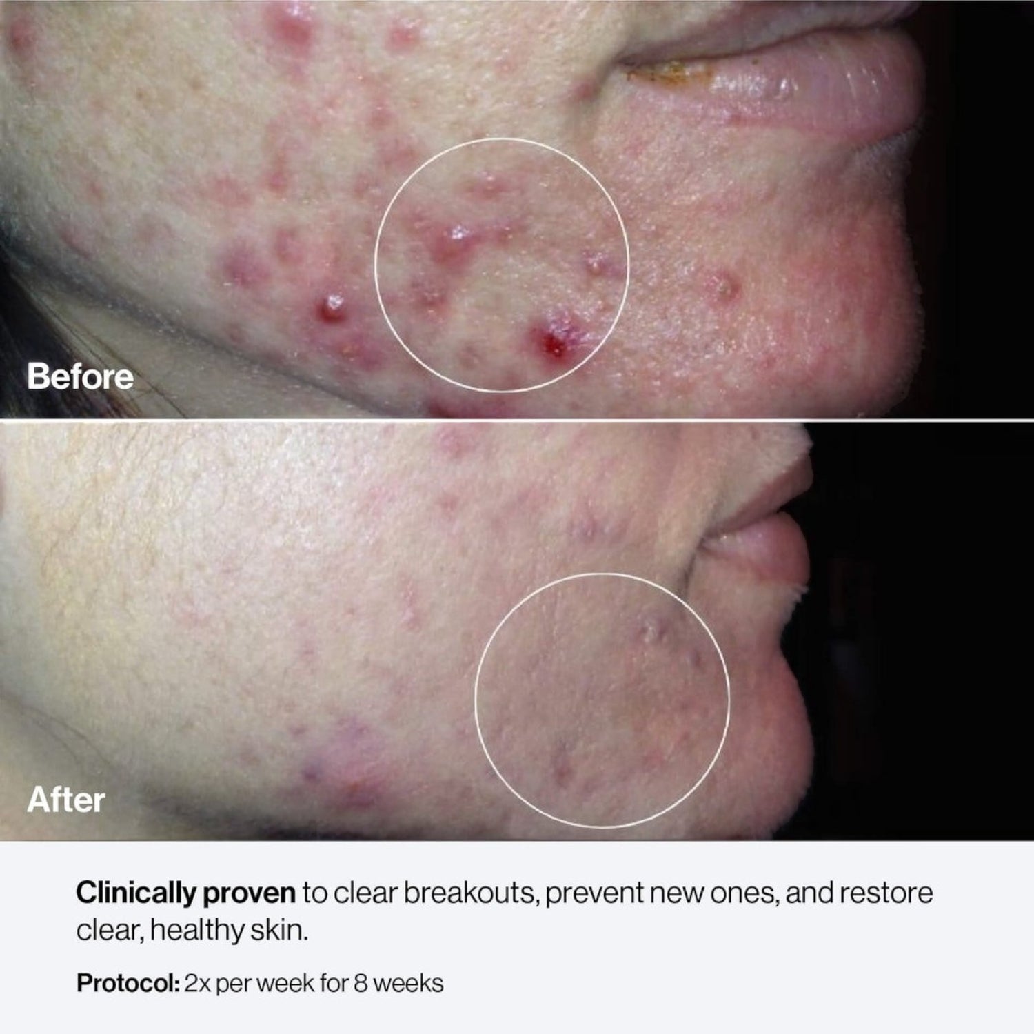 Shop Rescue Spa Celluma Mystique before and after results showing reduced acne breakouts and clearer skin texture.