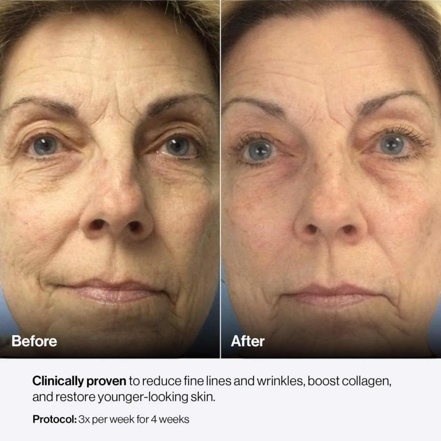 Shop Rescue Spa Celluma Mystique before and after results showing reduced fine lines and improved skin texture
