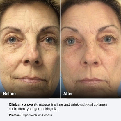 Shop Rescue Spa Celluma Mystique before and after results showing reduced fine lines and improved skin texture
