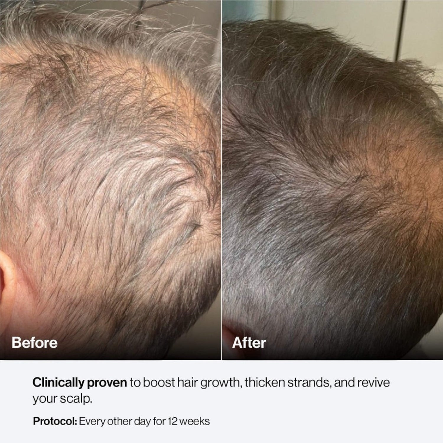 Shop Rescue Spa Celluma Mystique before and after results showing improved hair density and scalp health