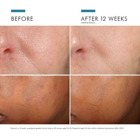 Shop Rescue Spa Phloretin CF before and after results showing reduced skin discoloration and improved texture