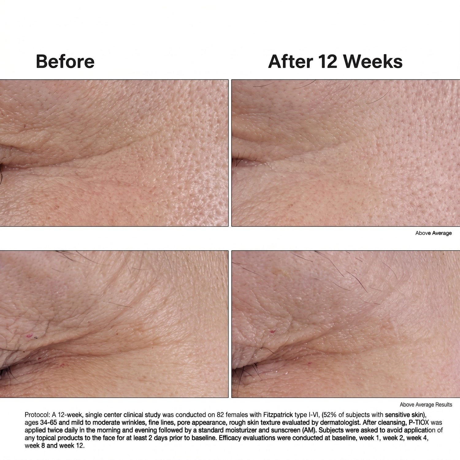 Shop Rescue Spa P-Tiox peptide serum clinical study showing before and after results of reduced expression lines