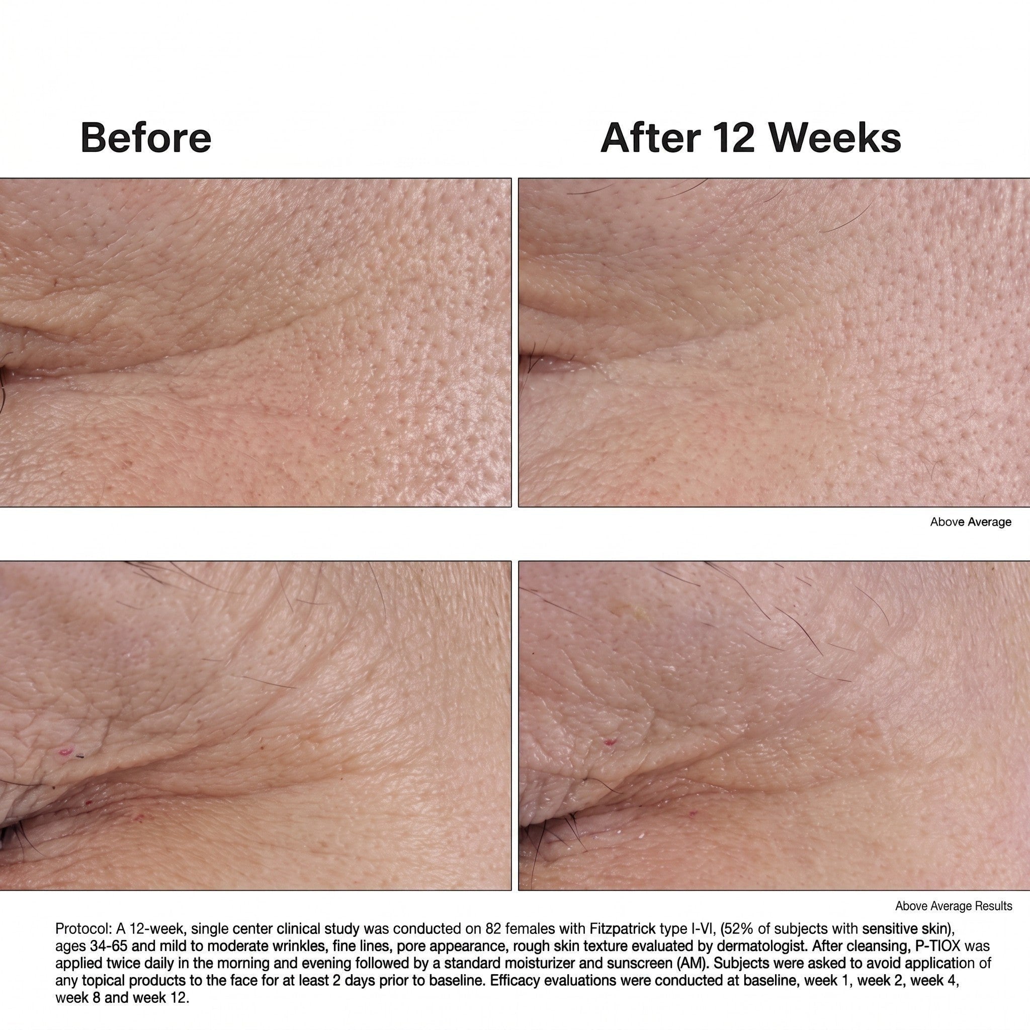 Shop Rescue Spa P-Tiox peptide serum clinical study showing before and after results of reduced expression lines